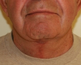 Feel Beautiful - Necklift San Diego Case 12 - After Photo